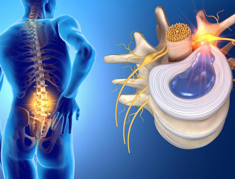 Bài thuốc trị Đau lưng Giải pháp hiệu quả cho vấn đề đau lưng